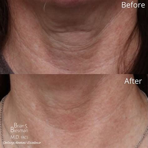 Diluted Radiesse to Tighten Skin on the Face and .